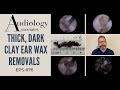 THICK, DARK CLAY EAR WAX REMOVALS - EP676