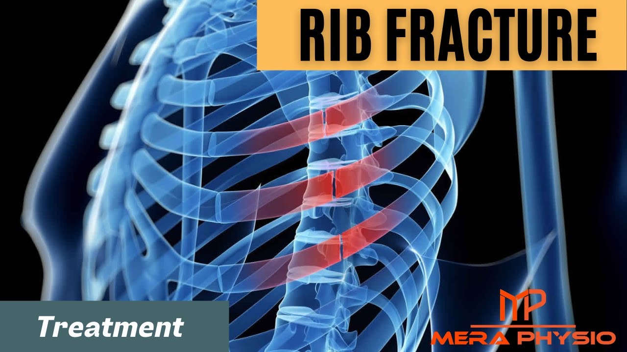 Rib Fracture Treatment In Hindi Mera Physio YouTube