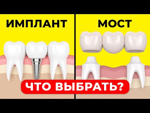 Мост или имплант, что лучше выбрать? / Имплантация зубов. Мост зубной