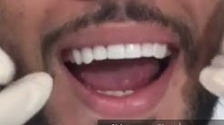 Dental Veneers In Dubai By Montreal International Clinic