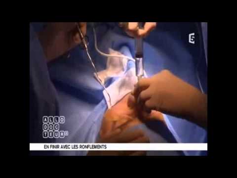 Vidéo: Chirurgie Du Ronflement: Options, Efficacité Et Coûts