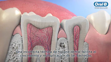 ¿Cuáles son las 5 causas de la caries dental?