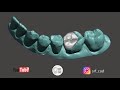 Meshmixer dental  come creare un intarsio inlay temporary  monolithic intraoral scan zirconia free