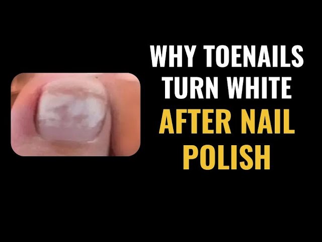 Nail Reconstruction Treatment | Nails by Toe Bro