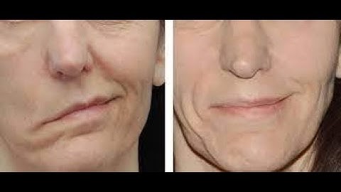 Decompression facial nerve  CPT code - simplify medical coding