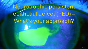 0112: Neurotrophic persistent epithelial defect (PED) - What