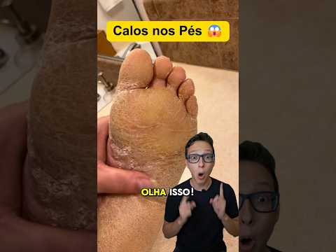 Calos nos Pés