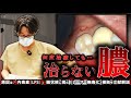 何度やっても治らない『膿…』「0.06mmの死角」樋状根に挑むレーザー無毒化！
