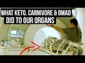 Keto, Carnivore & OMAD Put to the Test {full body MRI scan}