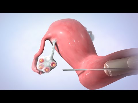 Video: In Vitro Fertilization