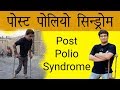Post Polio Syndrome Treatment || Lalit Kumar || WeCapable || Dashamlav