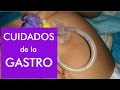 Gastrostomía / Lavado de sonda y como evitar taponamientos