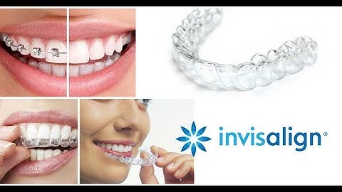 Niềng răng máng trong suốt INVISALIGN®💖💖💖