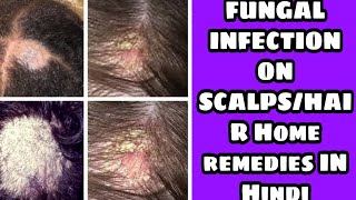 हेयर फंगस को दूर करने के लिए नुस्खें .hair fungal infection home treatment .@factsandmeinhindi