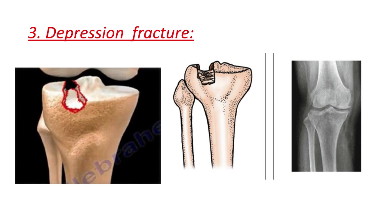 17-Fractures around the knee (Tibial plateau fracture ) Prof.Dr.Moheb Fadel  (For medical students)