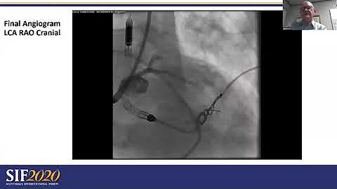 Acute Refractory Cardiogenic Shock Treated with PCI and Impella