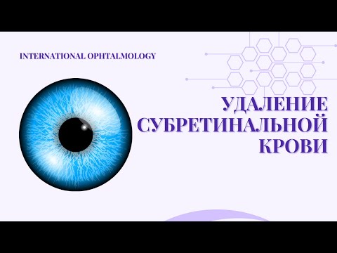 Удаление субретинальной крови