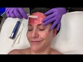 Revive medical spa prp facial