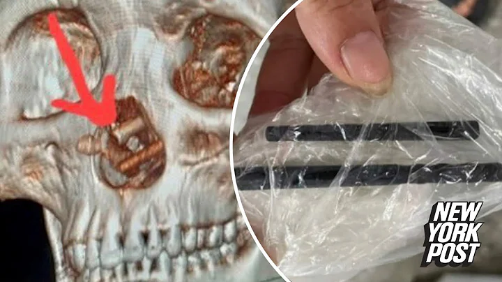 Man who suffered headaches for 5 months learns he had chopsticks stuck in his brain - DayDayNews