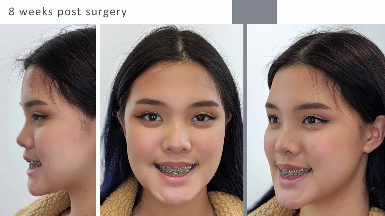 Corrective Jaw Surgery | Modern Digital Orthodontic Clinic