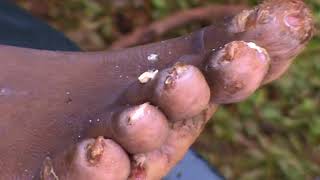Sammy of Maeni Jigger treatment (Follow Up) - 2 of 2