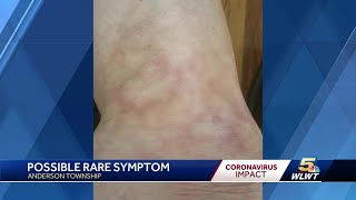 Skin rashes are possible rare symptom of the coronavirus