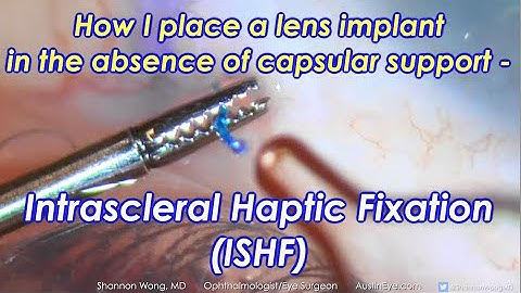 Intrascleral Haptic Fixation - ISHF.  How we place a monofocal lens into an eye with no capsule.