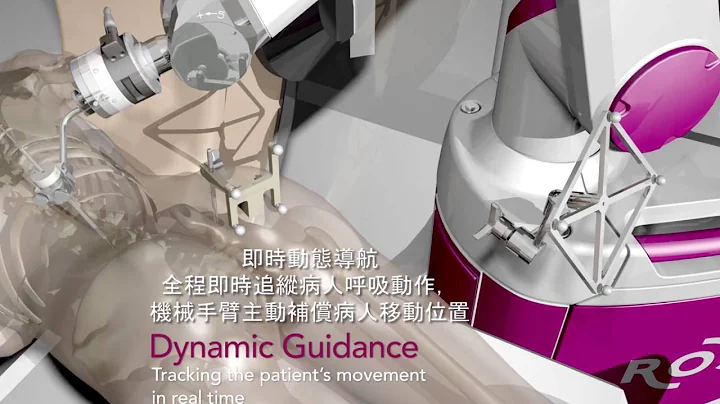 ROSA Spine 3D Video | Unison Healthcare Group友信醫療集團 - 天天要聞