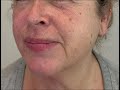 Láser Rejuvenecimiento facial tensar piel cuello Лазер омоложение подтяжка лифтинг лица шеи Аликанте