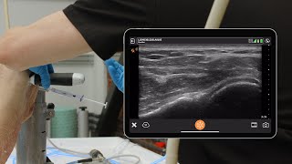 Glenohumeral Joint Injection
