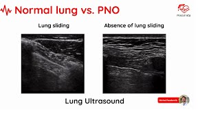 Lung ultrasound PRESENTATION