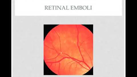 Ophthalmic Emergency: Central Retinal Artery Occlusion - Quick Review - DayDayNews