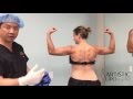 Celebrity Arms™ Liposuction | Ultra-Complete High -Definition | Lipo 360 Arms | Experts Dr. Su