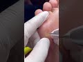 【スッキリ魚の目動画】魅せます#魚の目 #鶏眼 #フットケア #うおのめ #nails