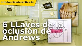 6 llaves de oclusión segun Andrews 6 llaves de oclusión segun Andrews