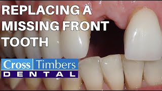 Case of the Week: Replacing a missing front tooth