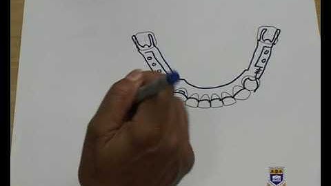 Designing a Lower Metal Partial Denture Kennedy Class III