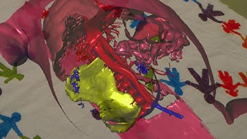 "X-ray vision" with the RadHA Augmented Reality app using Microsoft HoloLens