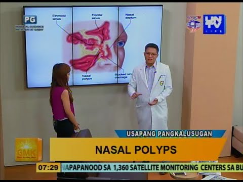 Video: Paano Gumamit ng Nasal Rinse: 13 Hakbang (na may Mga Larawan)