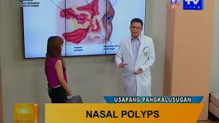 Good Morning Kuya: What is Nasal Polyps?
