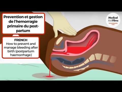 Vidéo: Hémorragie - Traitement Des Saignements Par Des Méthodes Et Moyens Alternatifs