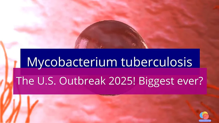 Largest Tuberculosis Outbreak in U.S. History – What You Need to Know & How to Stay Safe