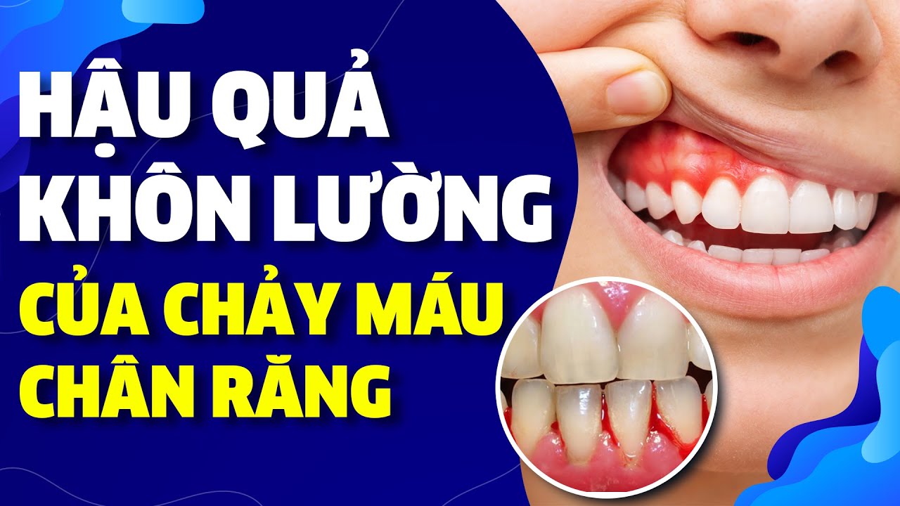 Outline Video Hậu Quả Khôn Lường Của Chảy Máu Chân Răng | Nam Bui Vinalign