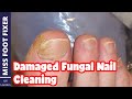 Damaged fungal nail Cleaning *** Fungal nail*** Full Treatment By Miss Foot Fixer