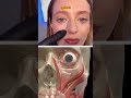 Gummy smile injection points