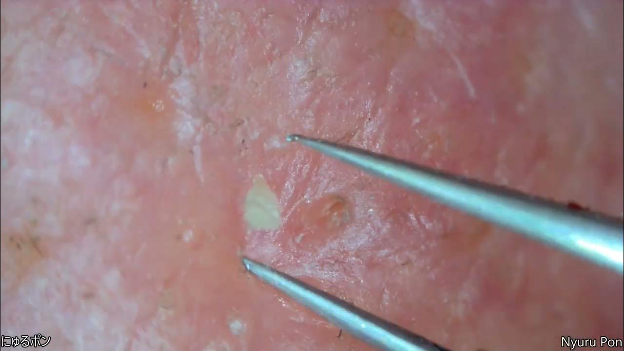 0189 keratin plug removal nose YouTube