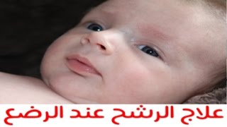 علاج الرشح عند الاطفال ( ارشادات لعلاج الرشح عند الاطفال  بالاضافة الى بعض الطرق للوقاية منه )