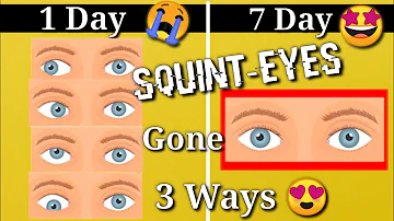 Squint Eye correction NATURALLY with exercises at Home