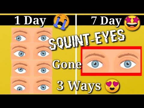 Squint Eye correction NATURALLY with exercises at Home