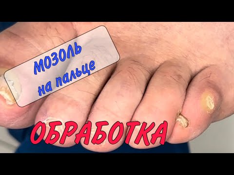 📌⚠️ МОЗОЛЬ НА ПАЛЬЦЕ / 💥обработка мозоли / 🔱 мозоли на ногах